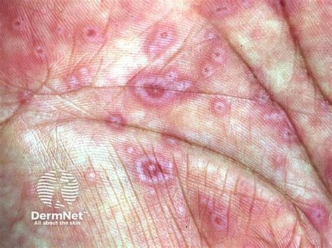 multiporm.net|Erythema multiforme .